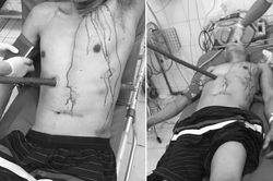 Ca cấp cứu hi hữu nạn nhân bị cọc gỗ đâm xuyên người