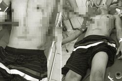 Trèo cây ngã, người đàn ông bị cây gỗ đâm xuyên bụng