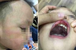 Cô giáo tát học sinh bầm tím mặt, tụ máu môi ở Hà Nội