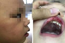 Hà Nội: Bé 3 tuổi bị cô giáo tát bầm mặt, tụ máu môi