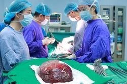 Lấy khối u máu khổng lồ trong gan của nữ bệnh nhân 59 tuổi