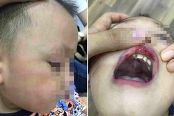 Cô giáo mầm non ở Hà Nội tát trẻ bầm dập, tụ máu môi