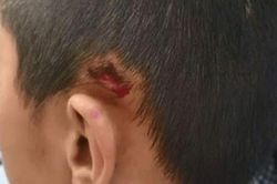 Thầy giáo đẩy học sinh ngã rách đầu vì nói chuyện riêng