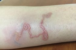 Kinh hoàng ấu trùng giun chó mèo 'đào hầm' dưới da