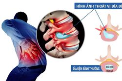 Các triệu chứng báo hiệu bệnh thoát vị đĩa đệm