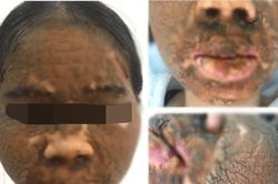 Ham trắng da, cô gái 24 tuổi mặt biến dạng sân sùi như vỏ cây