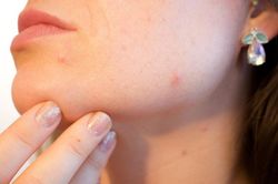 Thuốc nào trị giời leo?
