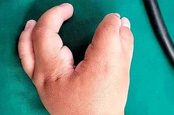 Bé trai 2 tuổi có tay chân dị tật như càng tôm hùm