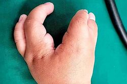 Bé trai bị dị dáng tứ chi hình càng cua từ trong bụng mẹ