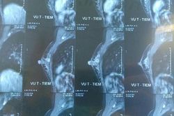 Gái trẻ chưa chồng sốc khi phát hiện mắc ung thư vú