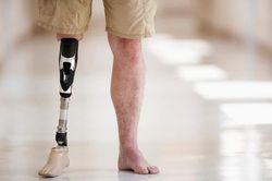Chứng rối loạn quái lạ khiến người bệnh muốn cắt tay chân