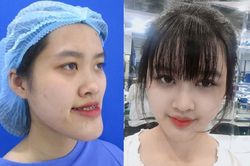 Nữ sinh trường Cảnh sát thay đổi ngoại hình sau phẫu thuật thẩm mỹ