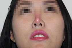 Kinh hoàng biến chứng nâng mũi: Lòi sụn, hoại tử lõm mũi