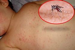 Cảnh báo gia tăng ca bệnh sốt xuất huyết do nắng nóng kéo dài