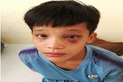 Nghịch súng tự chế, bé trai bị đinh kim loại ghim vào hốc mắt