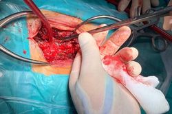 Mâu thuẫn trong đám cưới, nam thanh niên cầm que xiên thịt đâm bạn xuyên tủy sống