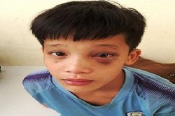 Phẫu thuật, lấy dị vật ở hốc mắt bệnh nhi tại Thanh Hóa