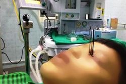 Nam sinh 13 tuổi bị 3 đinh kim loại găm xuyên vào mắt vì dùng súng tự chế