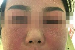Sử dụng mỹ phẩm trắng da cô gái phải nhập viện cấp cứu