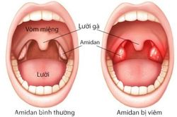 Dấu hiệu nhận biết, cách điều trị và phòng ngừa viêm amidan ở trẻ em