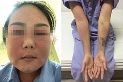 Cô gái bị phù nề mặt, nhiễm trùng toàn thân do dùng kem trắng da