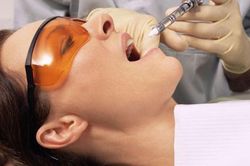 Làm gì sau khi nhổ răng khôn để mau lành và không đau nhức?