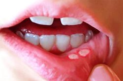 Những dấu hiệu 'tố cáo' cơ thể đang thiếu vitamin trầm trọng
