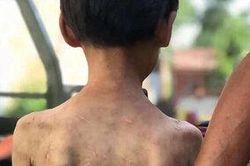 Xót xa cô bé 7 tuổi cơ thể chằng chịt vết thương vì bị bà đánh bằng dây cáp, dùng kìm bấm vào người