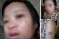 Người vợ mang bầu 8 tháng bị chồng đánh bầm dập vì dám đặt một đôi giày 135k trên mạng