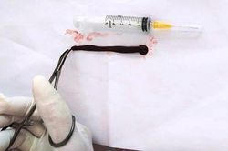 Uống nước suối, cậu bé 4 tuổi bị đỉa dài 10cm chui vào mũi