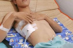 Hút thuốc suốt 6 năm, bệnh nhân phải phẫu thuật 3 lần trong 10 ngày