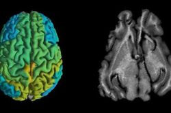 Kỹ thuật MRI mới giúp sớm phát hiện các căn bệnh thoái hóa thần kinh