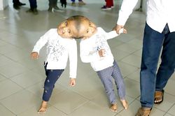 Bangladesh: Tách thành công cặp song sinh dính nhau phần đầu