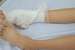 Bệnh lý hiếm gặp khiến chân cô bé 14 tuổi gấp thành 3 khúc