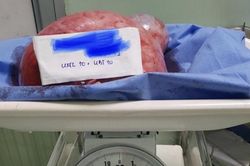 Người phụ nữ mang khối u to như bụng bầu sắp sinh