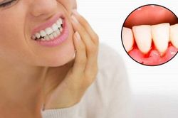 Chảy máu chân răng: Nguy cơ tiềm ẩn nhiều bệnh lý nguy hiểm chớ nên xem nhẹ