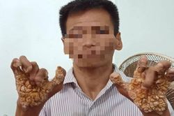 Ghi nhận căn bệnh 'người cây' xuất hiện ở Việt Nam