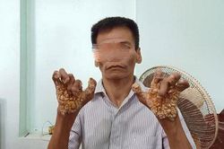 Bệnh 'người cây' nguy hiểm như thế nào?