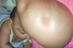 Xót xa lời khẩn cầu của mẹ bé gái có đầu phình to như quả bóng: 'Con gái tôi có thể được cứu mà'