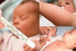 Không nên kiêng tắm, kiêng gió với trẻ bị sởi
