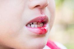 Bé trai thiếu máu do chảy máu răng trong 6 năm