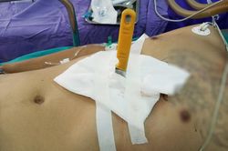 Cứu sống bệnh nhân bị hai nhát dao đâm thấu bụng