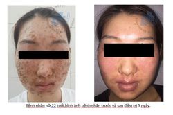 Gánh 'tai họa' vì mua bột rửa mặt làm đẹp trên mạng
