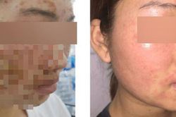 Da mặt cô gái sùi như vỏ cây sau khi dùng bột mua trên mạng để rửa mặt