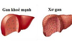 Căn bệnh xơ gan Hưng 'kính' mắc phải nguy hiểm như thế nào?