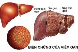 Viêm gan B, sát thủ thầm lặng gây ung thư gan phòng tránh thế nào cho hiệu quả