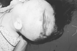 Bé gái 2 tuổi ở Hà Nội bị chó cắn hở xương sọ
