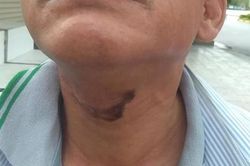 Người đi đường bị dây cáp viễn thông cứa cổ