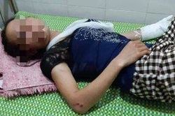 Điều tra vụ vợ bị chồng đánh gãy tay cùng nhiều vết thâm tím trên người