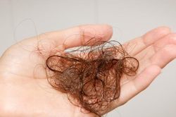 Bệnh nhi 5 tuổi bị tắc ruột vì ăn tóc